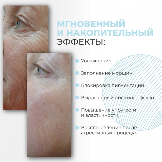 iFiller Bioderm
